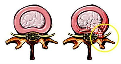 合肥医治腰椎间盘突出多少钱